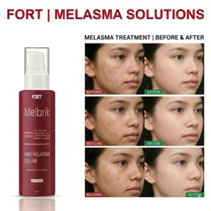 FORT Anti Melasma Cream 50ml – Freckles, Discoloration & Skin Texture Care